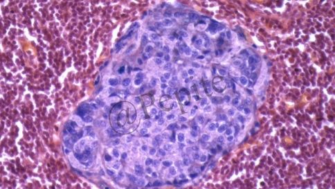 Identificate cellule killer contro il cancro.