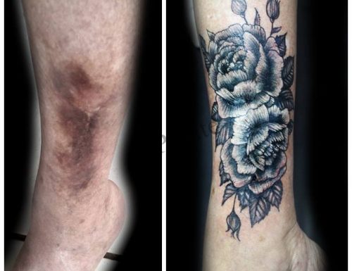 Un tatuaggio per alleviare una cicatrice